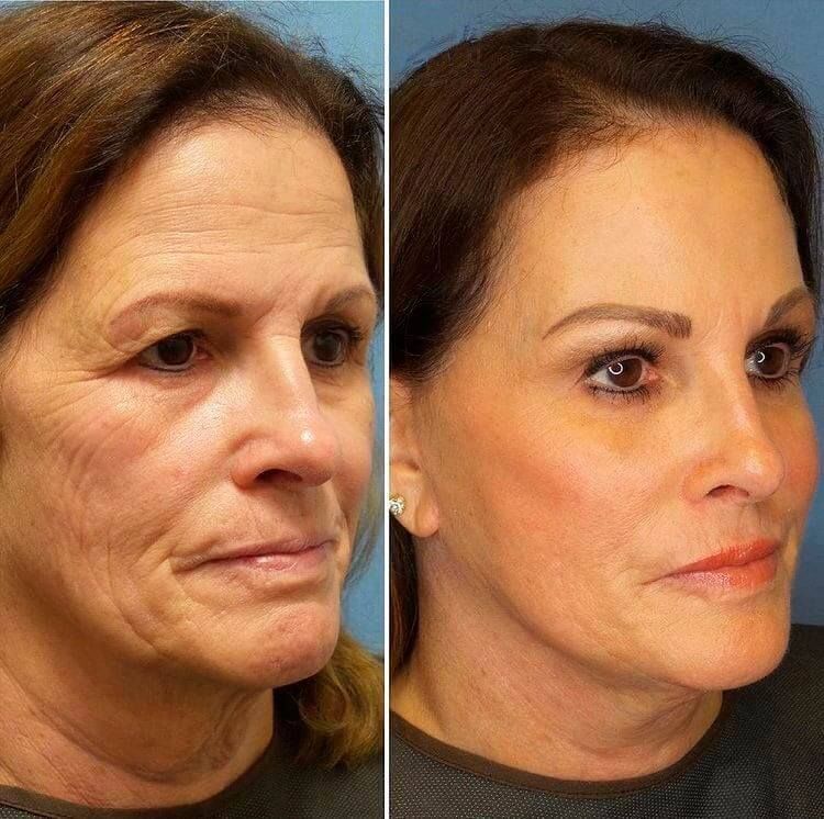 Hifu facelift