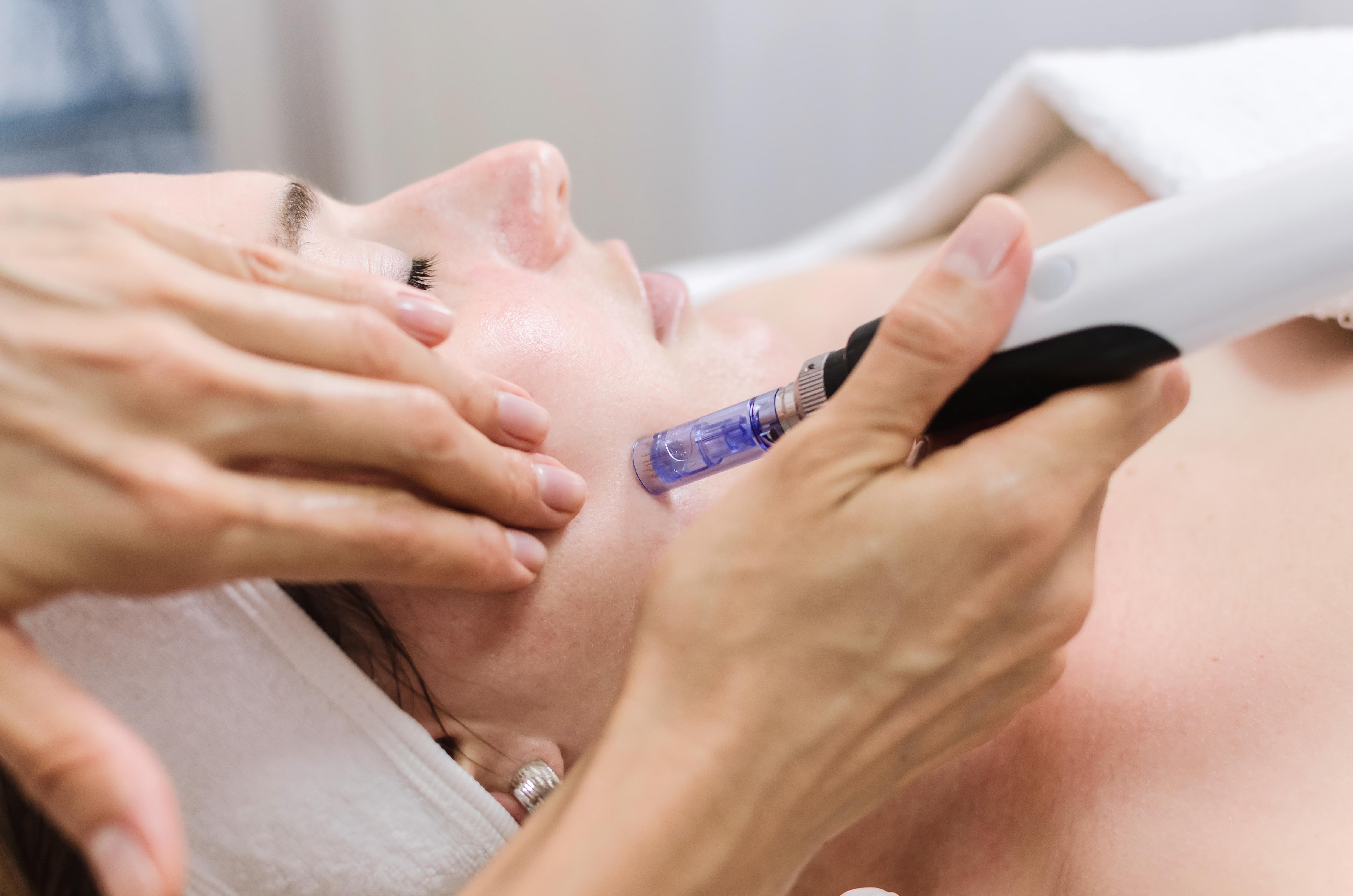 Dermapen huidverbeteren littekentherapie acne onzuivere huid acnelitteken