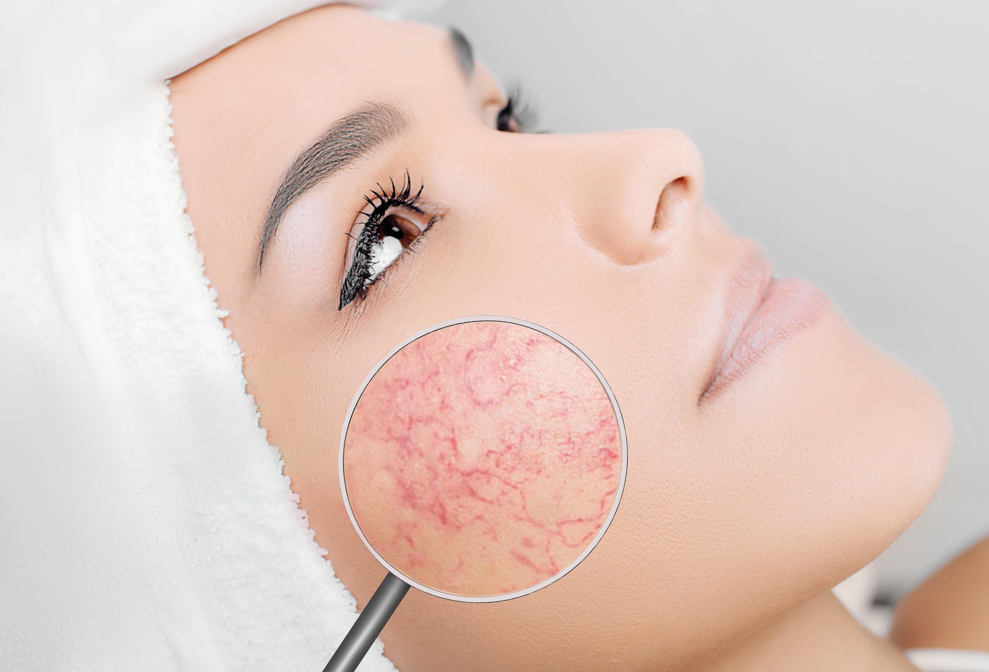 couperose (rode vaatjes) De huidtherapeute huidtherapie Couperosebehandeling nieuwegein rosacea behandeling nieuwegein
