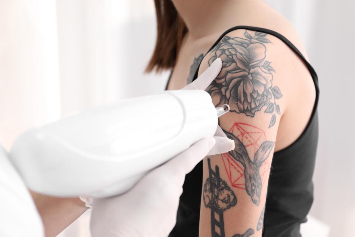 Tattooverwijderen nieuwegein tatoeageverwijderen